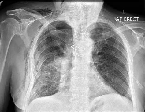 Loss of Lung Markings | Chest X-Ray - MedSchool