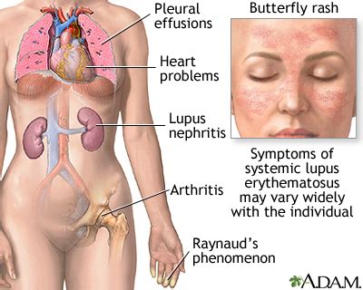 Systemic lupus erythematosus: MedlinePlus Medical Encyclopedia