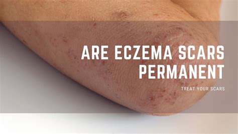 Are Eczema Scars Permanent - Treat Your Scars