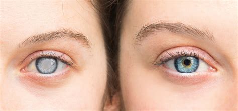 Cataracts vs. Glaucoma: Understanding the Differences - SightMD