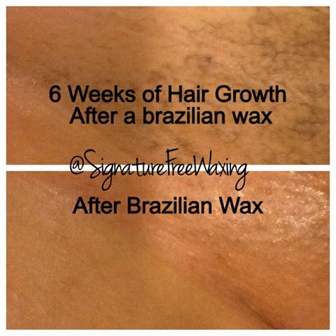 Top photo: 6 weeks after receiving a Brazilian wax at Signature Free ...