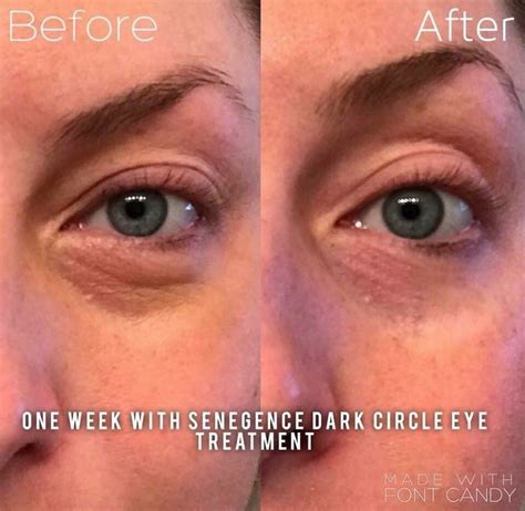 Dark Circle Eye Cream #SkinTighteningCream | Dark circles treatment ...