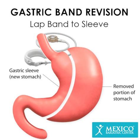 Lap-Band Revision Surgery in Mexico - Mexico Bariatric Center