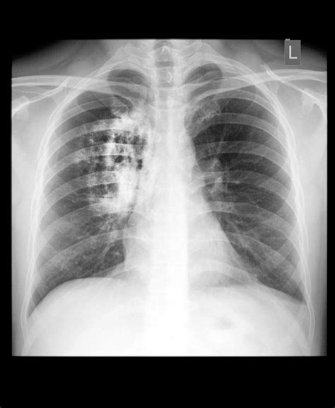 Lung Cancer | Lung Cancer Symptoms | MedlinePlus