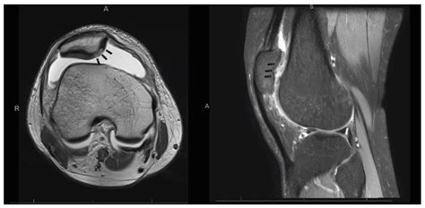 Life | Free Full-Text | Management of Patellar Chondral Defects with ...