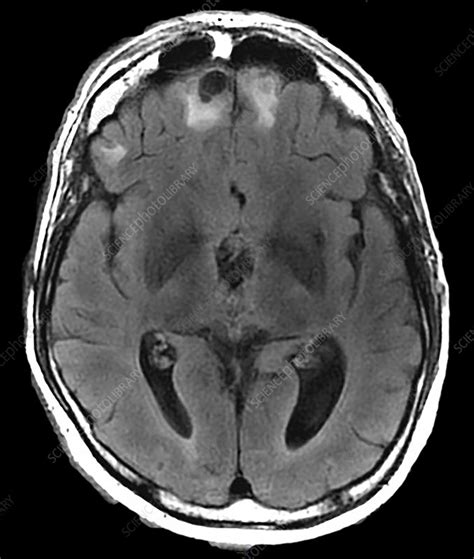 Chronic Post-Traumatic Brain Injury, MRI - Stock Image - C030/6071 ...