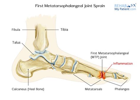 First Metatarsophalangeal Joint Sprain | Rehab My Patient