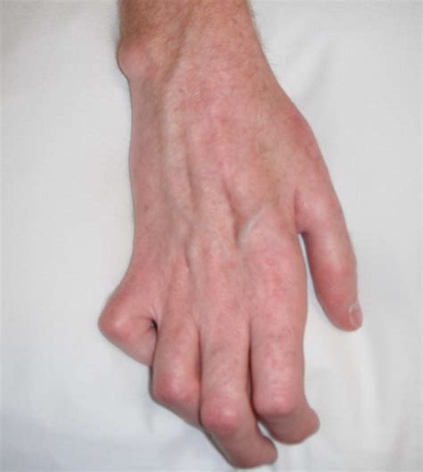 Claw hand causes, signs, symptoms, diagnosis and claw hand treatment