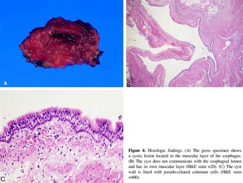 Figure 2 from An esophageal duplication cyst that presented with sudden ...