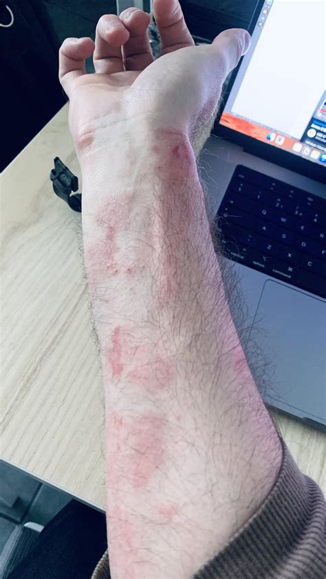 Dupixent side effects: red, hot, splotchy face? : r/eczema