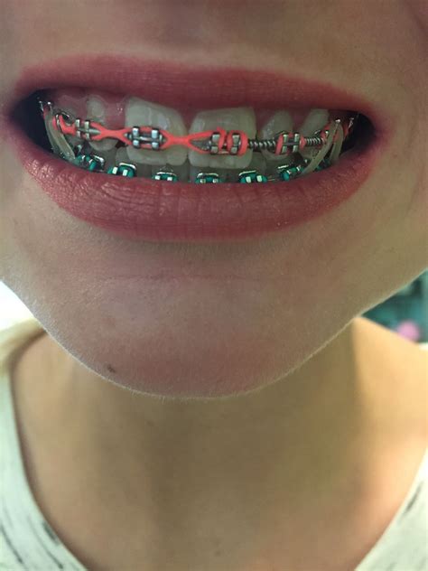 √ Light Blue Braces Color