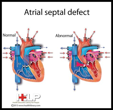 Atrial Septal Defect... technical term for Layci's condition, | Atrial ...