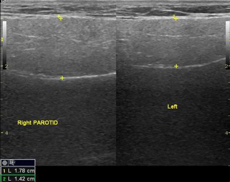 Parotid Gland Ultrasound