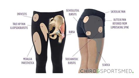 Trochanteric bursitis