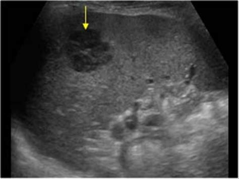 Malignant lymphoma | Ultrasound sonography, Obstetric ultrasound ...