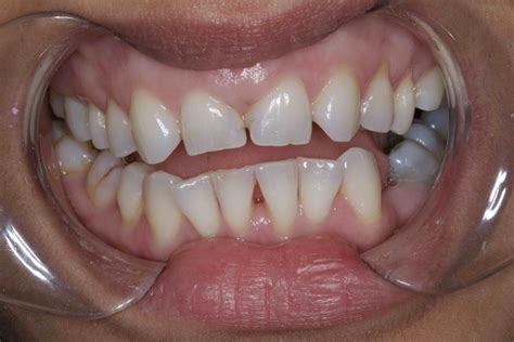 short and worn down front teeth bonding procedure before