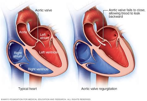 Aortic valve disease - Symptoms and causes - Mayo Clinic