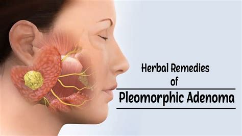 Pleomorphic adenoma is the most common type of benign salivary gland ...