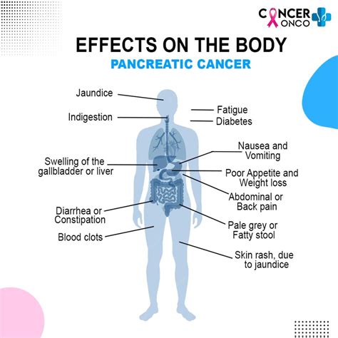 Pancreatic Cancer Treatment and Its 5 Stages