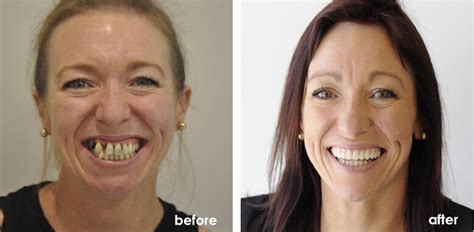 Teeths Before And After - Dental News Network