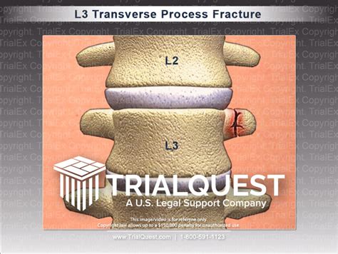 L3 Transverse Process Fracture - TrialExhibits Inc.