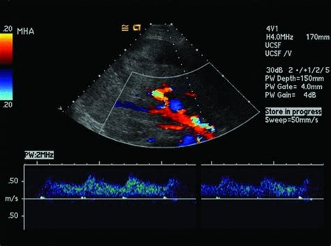 A. Duplex ultrasound of the allograft main hepatic... | Download ...