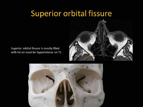 Superior Orbital Fissure Radiology