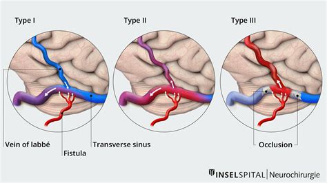 Dural Arteriovenous Fistula Classification Download Scientific Diagram ...