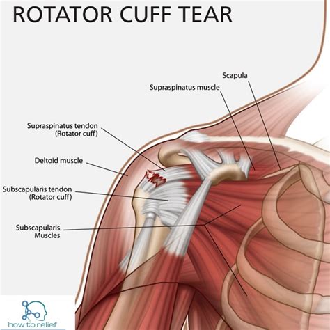 Rotator Cuff Tear! Symptoms, Causes, Diagnosis, Treatment & Exercises ...