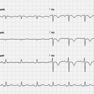 Discharge EKG-normalization of QTc. EKG, electrocardiogram. | Download ...