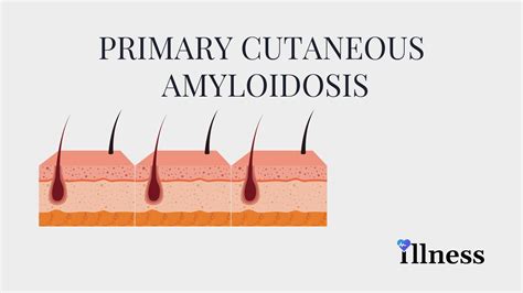 Primary Cutaneous Amyloidosis : Overview, Causes, Symptoms, Treatment ...