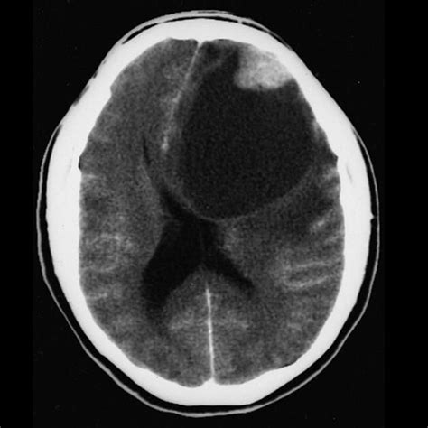 Pleomorphic xanthoastrocytoma | Radiology Reference Article ...