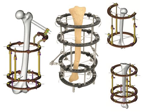 Ultimate Guide of External Fixator | Orthopromed Inc. Medical