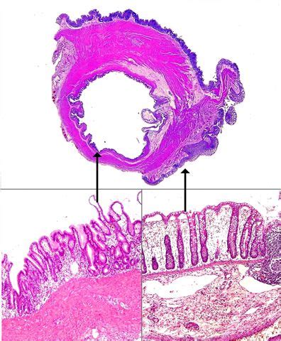 Pathology Outlines - Duplication