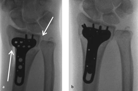 17 Common Errors of Volar Plate Fixation | Musculoskeletal Key