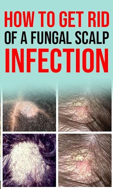 How To Get Rid Of A Fungal Scalp Infection Causes, Symptoms, And ...