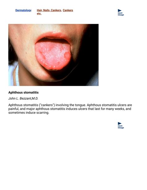 Aphthous stomatitis