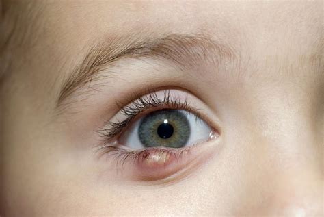 Chalazion Eyelid Bump Symptoms and Treatments