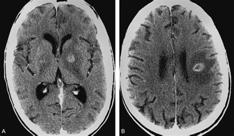 HIV and other Retroviral Infections of the Nervous System | Neupsy Key