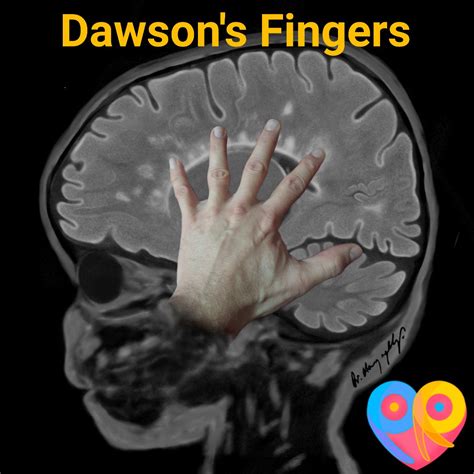 Multiple Sclerosis Mri Dawsons Fingers