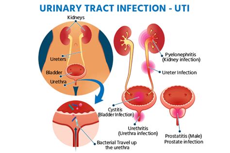 Can Escherichia coli be Sexually Transmitted?