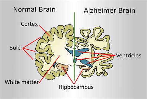 File:Brain-ALZH.png - Wikimedia Commons