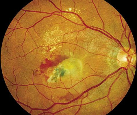 Choroidal Neovascularization Enlargement Might Guide Treatment in Some ...