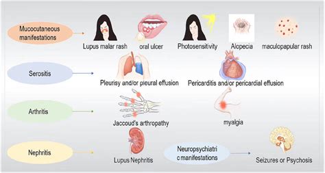 Main clinical manifestations of systemic lupus erythematosus. Systemic ...