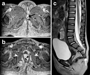 An MRI in a 1-year-old girl with cloacal malformation. (Axial ...