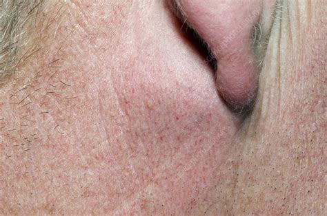 Sebaceous cyst behind the ear - Stock Image - C016/9251 - Science Photo ...