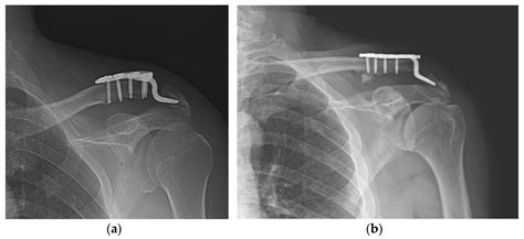 JCM | Free Full-Text | Complications and Frequency of Surgical ...