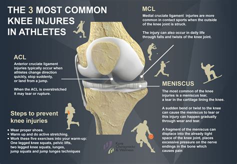 The 3 Most Common #KneeInjuries in #Athletes: 🏃‍♀🏃- Anterior cruciate ...