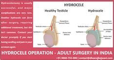 Hydrocele operation