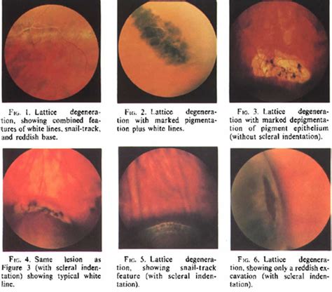 Lattice degeneration of retina causes, symptoms, diagnosis, prognosis ...